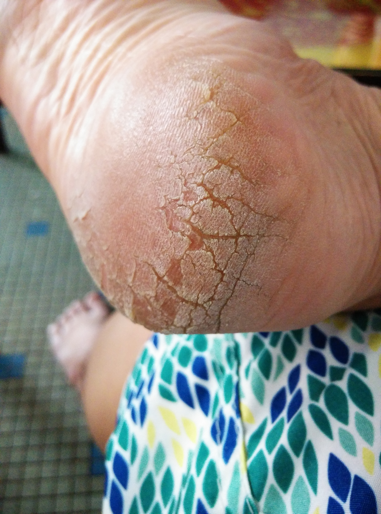 Close-up shot of cracked heel - left and right feet.